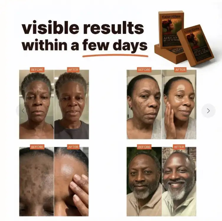 Anti-Dark Spots & Acne African Black Soap