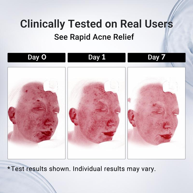Dr. Leo's Salicylic Acid Drying Lotion for Acne Treatment